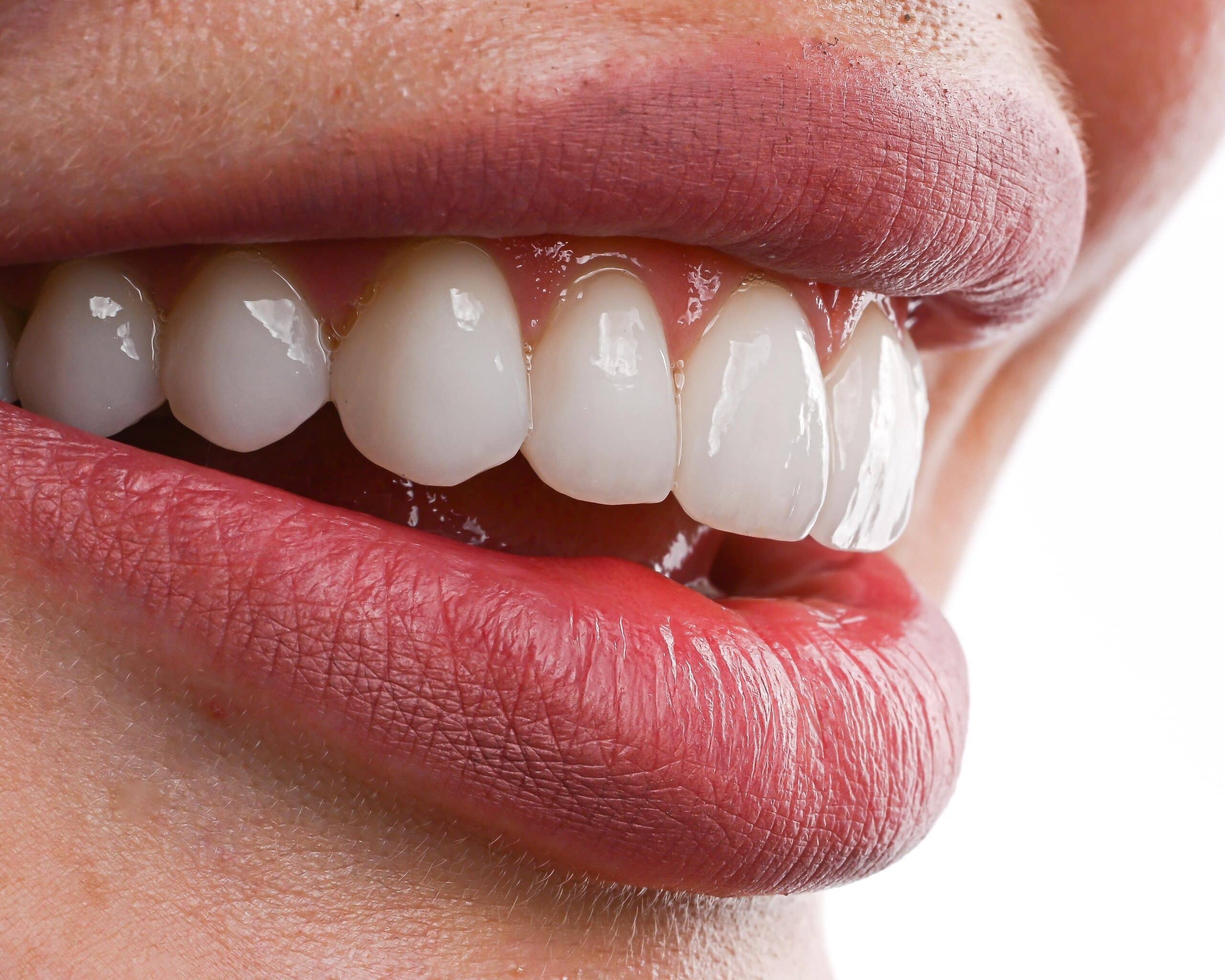 Perfekte Frontzähne nach Behandlung mit Veneers im Rahmen einer Fortbildung für Zahnärzte und ästhetische Zahnmedizin.